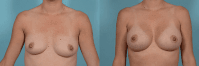 Case 7995 - Woman treated with Breast Augmentation
