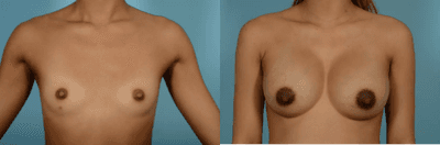 Case 7996 - Woman treated with Breast Augmentation