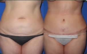 Case 8 - Woman treated with Tummy Tuck