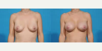 Case 8031 - 25-34 year old woman treated with Breast Implants, Breast Augmentation, Inspira Breast Implants, Natrelle Breast Implants