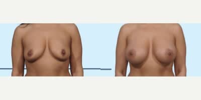 Case 8034 - Woman treated with Breast Implants