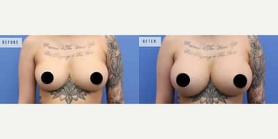 Case 8037 - Woman treated with Breast Augmentation, Breast Implants