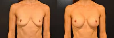 Case 8038 - Woman treated with Breast Augmentation, Breast Implants