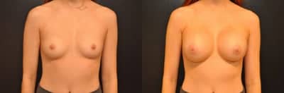 Case 8039 - Woman treated with Breast Augmentation, Breast Implants