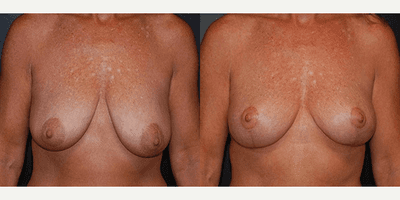 Case 8151 - Woman treated with Breast Lift, Breast Reduction