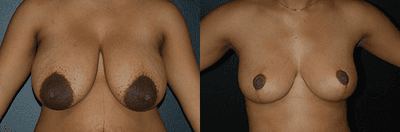Case 8152 - Woman treated with Breast Lift, Breast Reduction