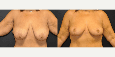 Case 8153 - Woman treated with Breast Lift, Breast Reduction