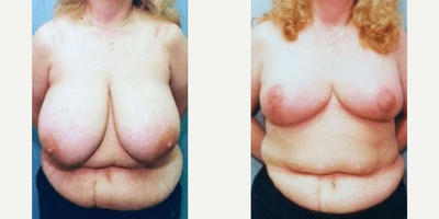 Case 8156 - Woman treated with Breast Reduction