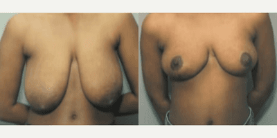 Case 8158 - Woman treated with Breast Reduction