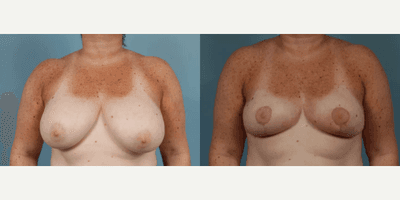 Case 8174 - Woman treated with Breast Reduction