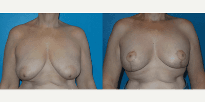 Case 8180 - Woman treated with Breast Reduction