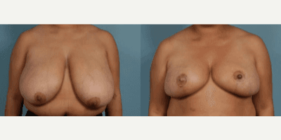 Case 8216 - Woman treated with Breast Reduction