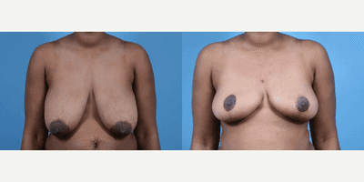 Case 8232 - Woman treated with Breast Reduction