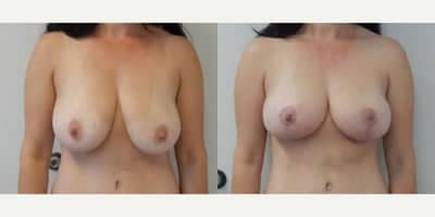 Case 8272 - Woman treated with Breast Lift