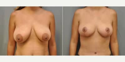 Case 8273 - Woman treated with Breast Lift
