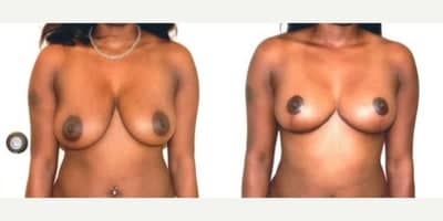 Case 8274 - Woman treated with Breast Lift