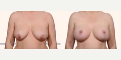 Case 8277 - Woman treated with Breast Lift