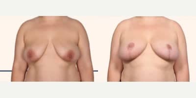 Case 8278 - Woman treated with Breast Lift