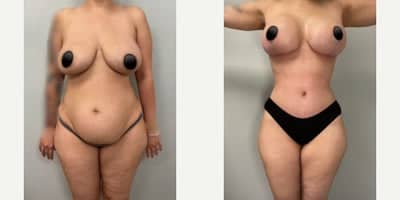 Case 8279 - Woman treated with Breast Lift
