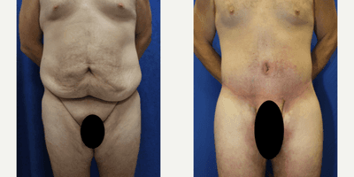 Case 8391 - 25-34 year old man treated with Body Lift
