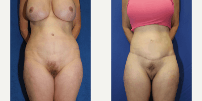 Case 8395 - 55-64 year old woman treated with Body Lift