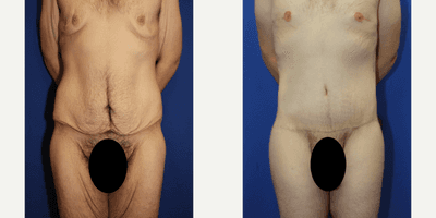 Case 8396 - 35-44 year old man treated with Body Lift