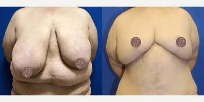 Case 8397 - 45-54 year old woman treated with Body Lift, Breast Augmentation