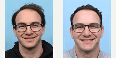 Case 8513 - 25-34 year old man treated with FUE Hair Transplant, Hair Transplant, Hair Loss Treatment, PRP for Hair Loss