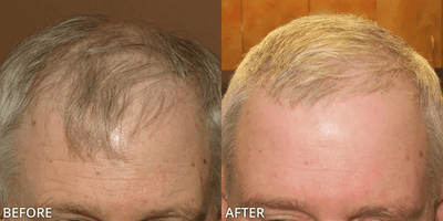 Case 8516 - Man treated with ARTAS Robotic Hair Transplant, Hair Transplant