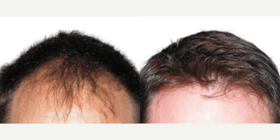 Case 8519 - Man treated with Hair Transplant