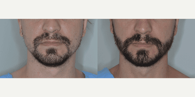 Case 8632 - Man treated with Beard Transplant