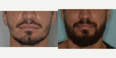 Case 8639 - 35-44 year old man treated with Beard Transplant, FUE Hair Transplant