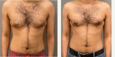Case 8751 - 25-34 year old man treated with Gynecomastia Surgery