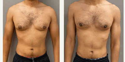 Case 8752 - 18-24 year old man treated with Gynecomastia Surgery