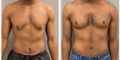 Case 8754 - 25-34 year old man treated with Male Tummy Tuck, Gynecomastia Surgery, Masculinizing Top Surgery