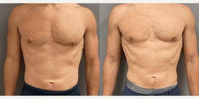 Case 8755 - 35-44 year old man treated with Gynecomastia Surgery