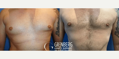 Case 8757 - Woman treated with Gynecomastia Surgery