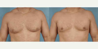Case 8797 - Man treated with Gynecomastia Surgery