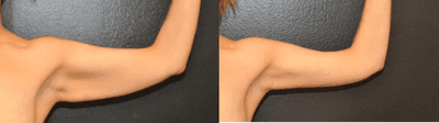 Case 8870 - 34 year old woman treated with Arm Lift, Liposuction