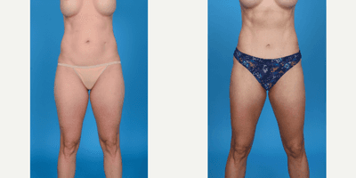 Case 8871 - 35-44 year old woman treated with Abdominal Etching, Belly Button Surgery, Diastasis Recti Repair, Drainless Tummy Tuck, Liposcu