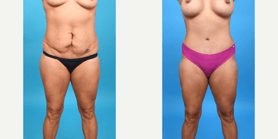 Case 8876 - 25-34 year old woman treated with Abdominal Etching, Diastasis Recti Repair, Drainless Tummy Tuck, Liposuction, Mini Tummy Tuck,