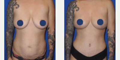 Case 8877 - Woman treated with Breast Lift, Breast Fat Transfer, Tummy Tuck, Liposuction, Mommy Makeover