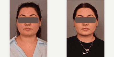 Case 8990 - Woman treated with Chin Liposuction