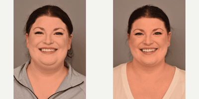 Case 8991 - Woman treated with Chin Liposuction