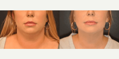 Case 8993 - 25-34 year old woman treated with Chin Liposuction