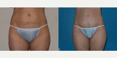 Case 91 - Woman treated with Tummy Tuck