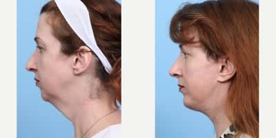 Case 9110 - 45-54 year old woman treated with Chin Implant, Deep Plane Facelift