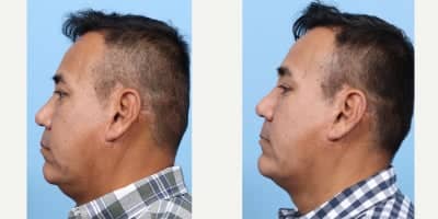 Case 9111 - 55-64 year old man treated with Chin Implant, Facial Fat Transfer
