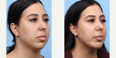 Case 9114 - 25-34 year old woman treated with Chin Implant, Rhinoplasty