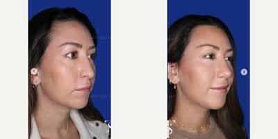 Case 9115 - 35-44 year old woman treated with Chin Implant, Revision Rhinoplasty